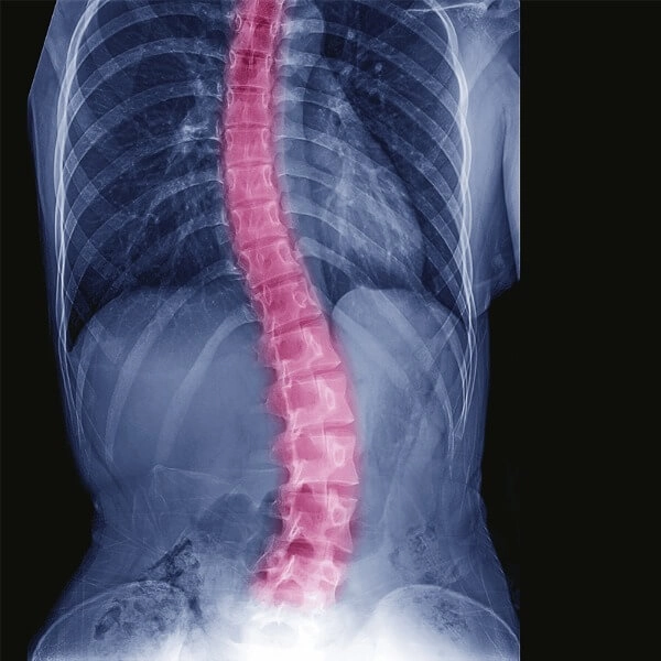 World Spine Day 2018