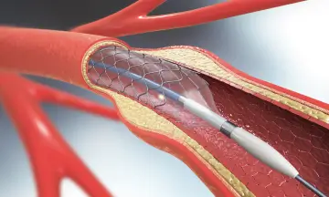 Angiogram vs. Angioplasty: Types, Procedure, Risks & Benefits Explained