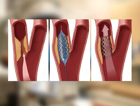 Chronic Total Occlusion (CTO) Angioplasty | Heart Block Treatment in India | Interventional Cardiologists in Bangalore - Sakra World Hospital