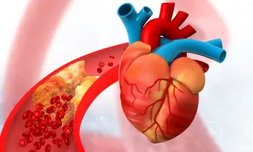 Coronary Artery Disease