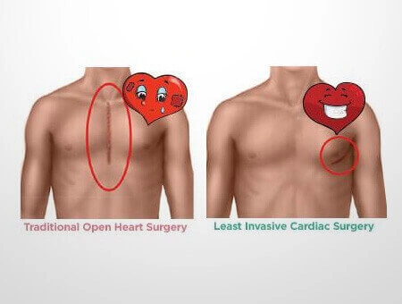 Least Invasive Cardiac Surgery | Minimal Invasive Cardiac Surgery | Best Cardiac Surgery Hospital in Bangalore - Sakra World Hospital