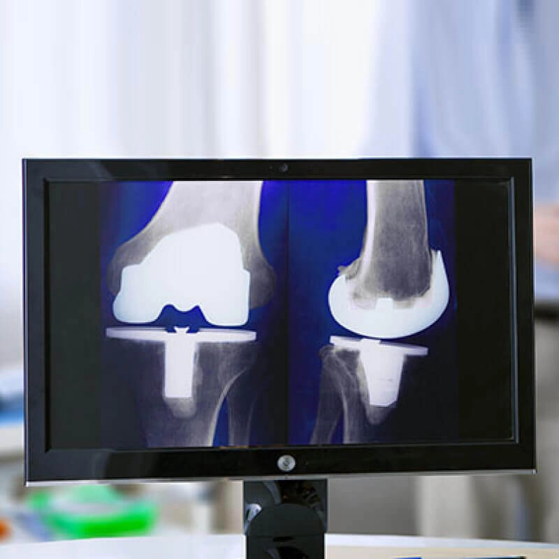 Blog on Knee Replacement Surgery - Best Orthopaedic Surgeon at Sakra