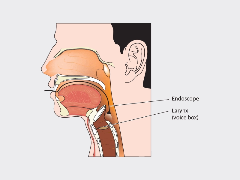 NBI for Upper Aerodigestive Tract Cancers | Head & Neck Cancer Screening & Diagnosis  - Sakra World Hospital