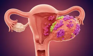 Ovarian Cysts treatment & management