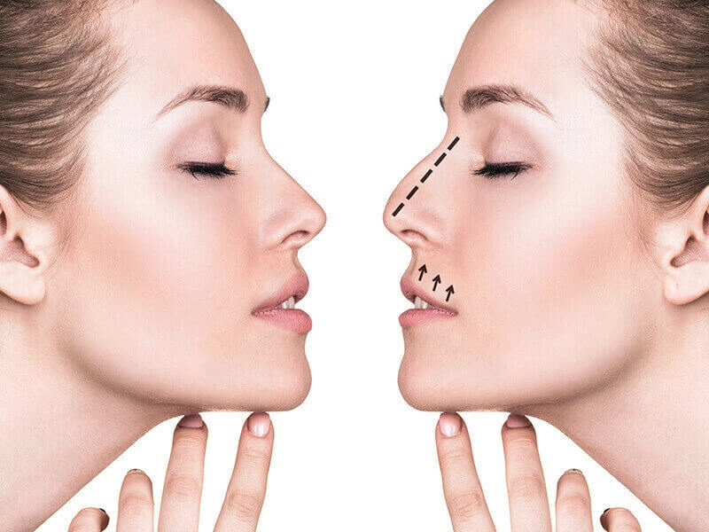 Rhinoplasty - Plastic Surgery of Nose