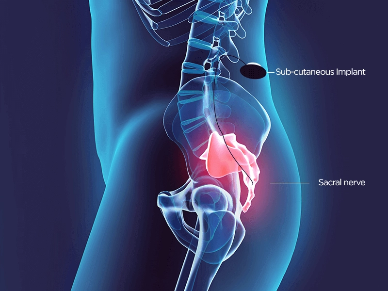 Sacral Neuromodulation for Bladder and Bowel Problems - Sakra World Hosopital