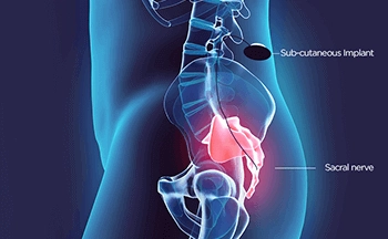 Sacral Neuromodulation for Bladder and Bowel Problems - Sakra World Hosopital