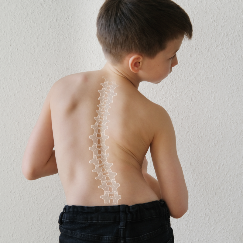 How to Know If You Have Scoliosis: Tips and Early Prevention