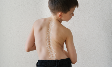 How to Know If You Have Scoliosis: Tips and Early Prevention
