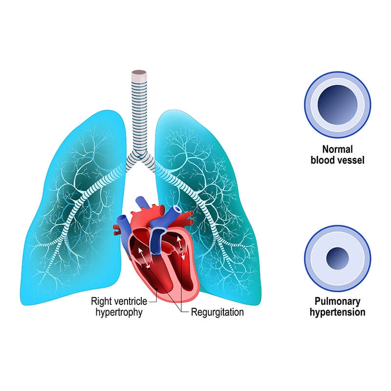 pulmonary hypertensio a progressive lung disease