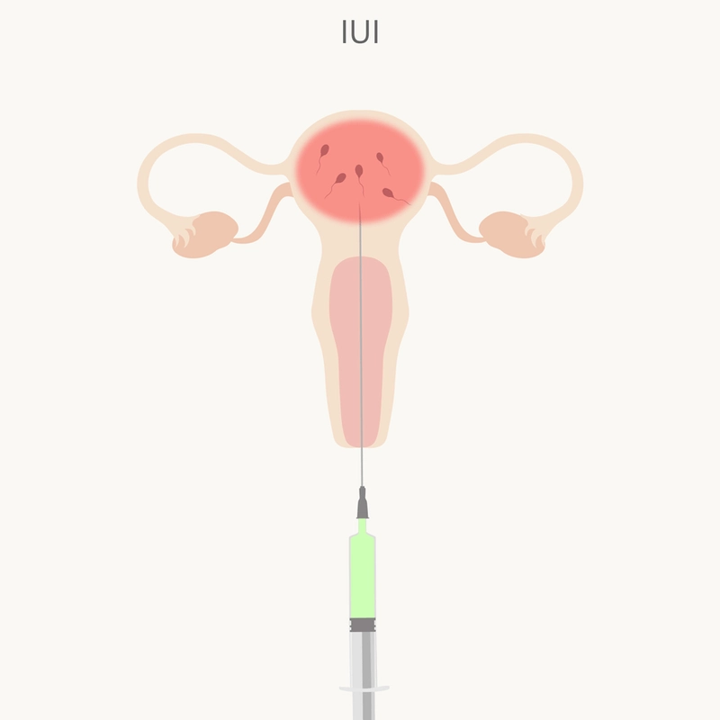 IUI Specialist in Bangalore