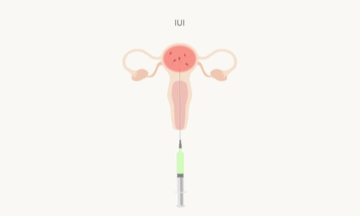 IUI Specialist in Bangalore