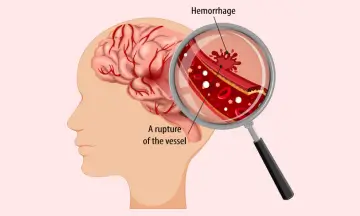 Brain Hemorrhage causes 