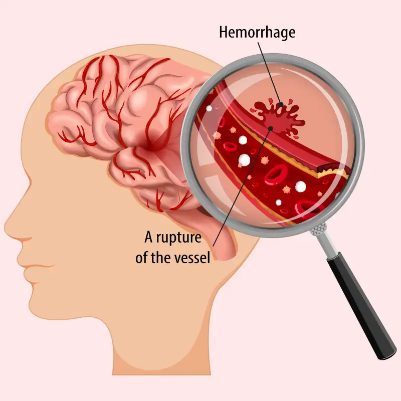 Brain Hemorrhage causes 