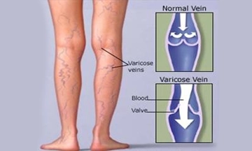 Understanding EVLT