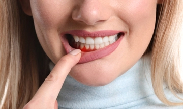 gingivitis treatment in bangalore