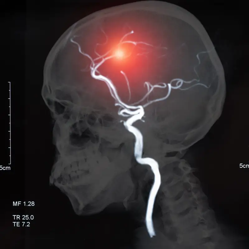 Hemorrhagic Stroke causes 