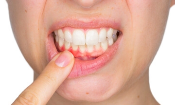 Bleeding Gums Treatment