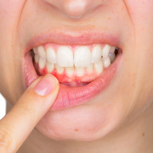 Bleeding Gums Treatment