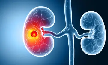 what causes kidney cancer