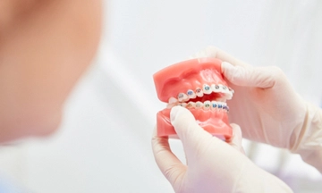 malocclusion treatment in bangalore