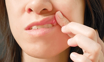 aphthous ulcers, aphthous mouth ulcers treatment