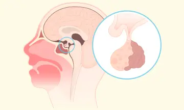  Pituitary Tumors