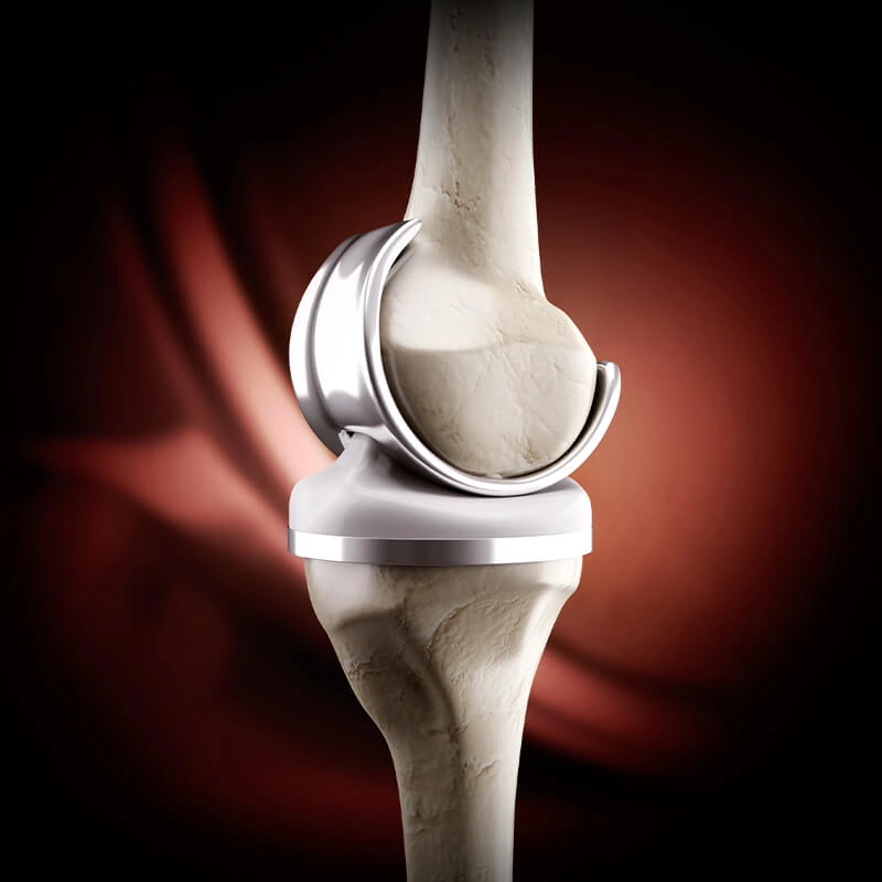 knee replacement surgery in bangalore