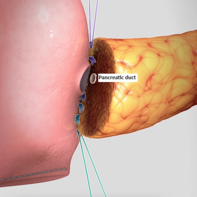 Pancreas Surgery