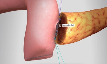 Pancreas Surgery