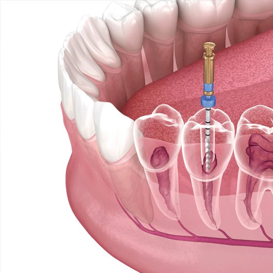 root canal treatment in bangalore