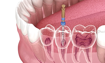 root canal treatment in bangalore