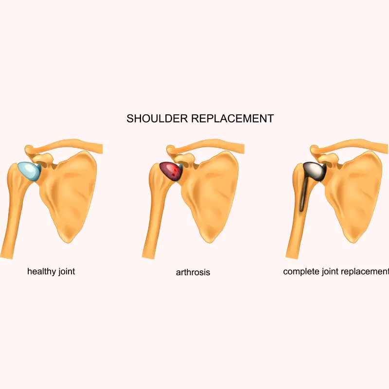 Shoulder Arthroplasty Causes