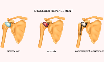 Shoulder Arthroplasty Causes