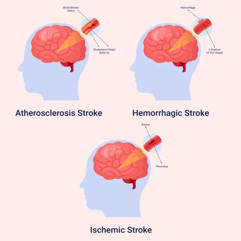 Stroke Symptoms