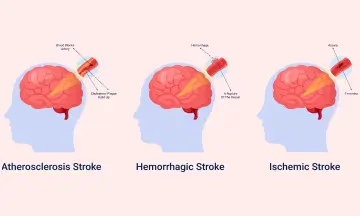 Stroke Symptoms
