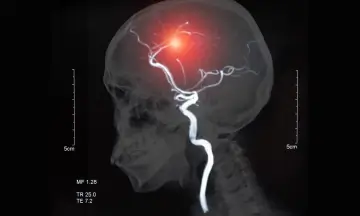 Hemorrhagic Stroke causes 