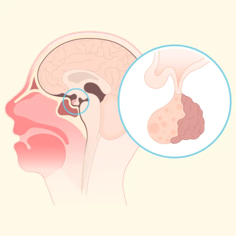  Pituitary Tumors